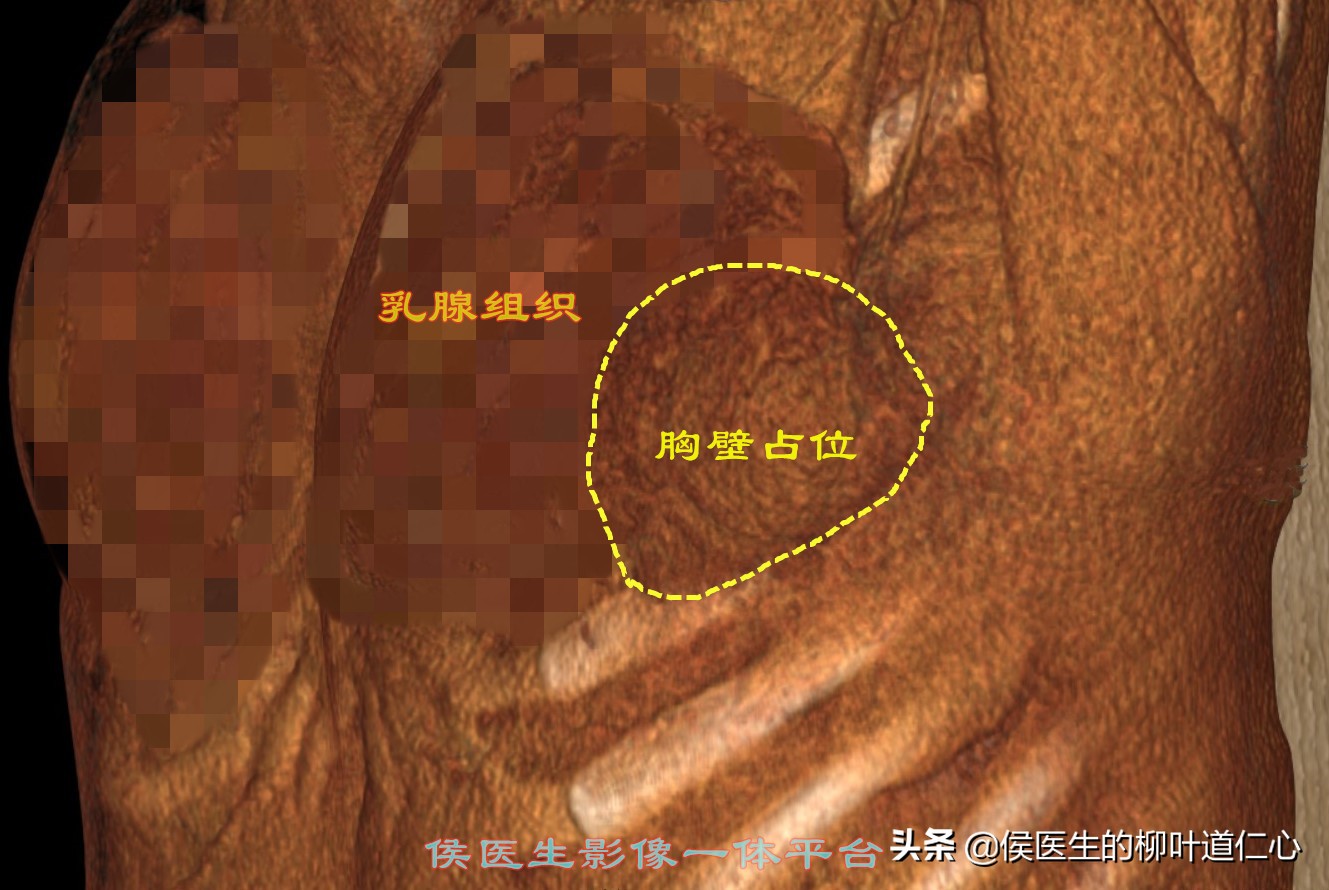 结核杆菌会引起肺结节吗,肺结节诊断为肺结核