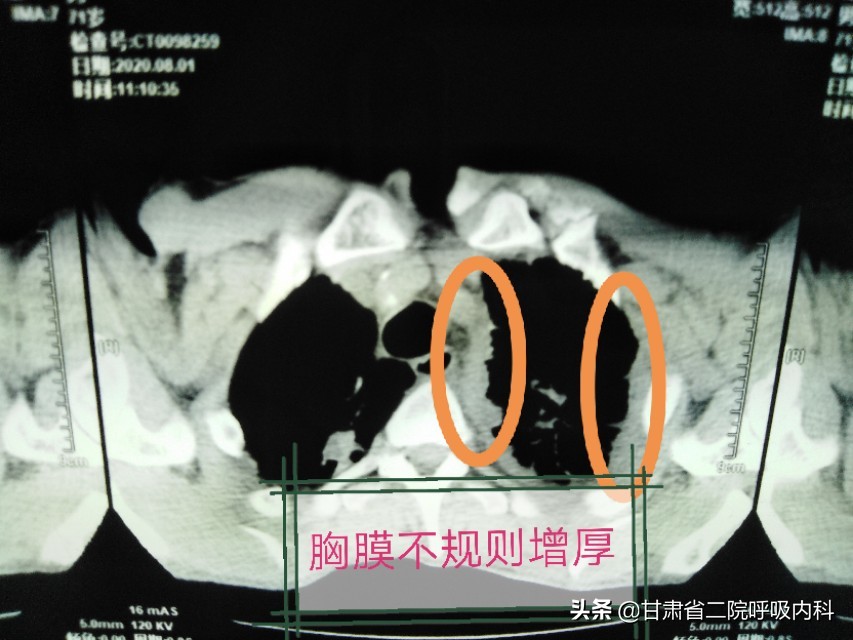 老人咳嗽胸腔积液怎么消除和恢复,老年人反复胸腔积液怎么回事