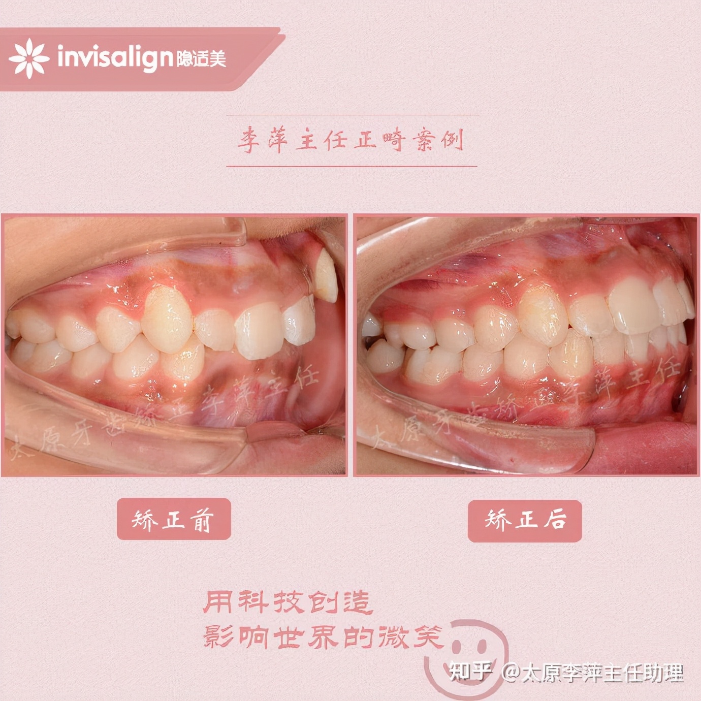 重度拥挤矫正牙齿适合隐形牙套吗,广州成人牙齿矫正推荐隐形牙套