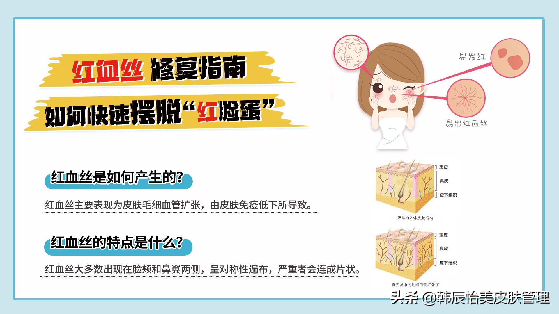 修护红血丝摆脱大红脸,红血丝修复指南快速摆脱红脸蛋