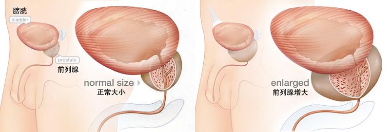 前列腺肥大并钙化灶什么症状,年轻人有前列腺肥大
