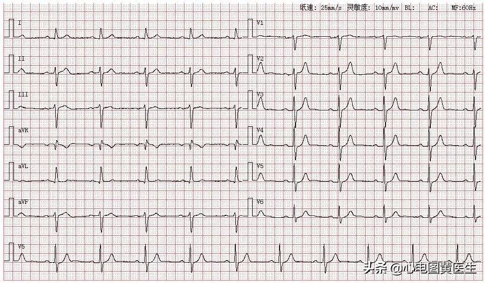 左前分支传导阻滞前胸痛怎么办,左前分支传导阻滞趋势