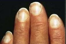 小小的指甲隐藏大大的健康秘密,小小指甲大调查