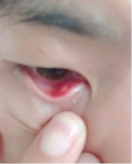 高中生眼周围红是怎么回事,高中生眼睛红肿是什么原因