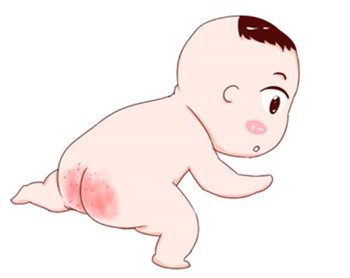 新生儿红屁股怎么快速消除,新生儿红屁股的处理方法
