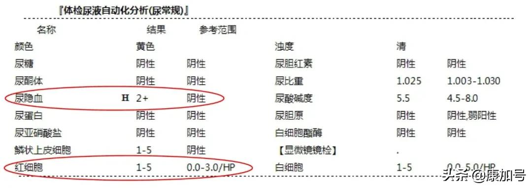 读懂体检单丨尿常规检查，能看出来肾好不好？一文教你看懂