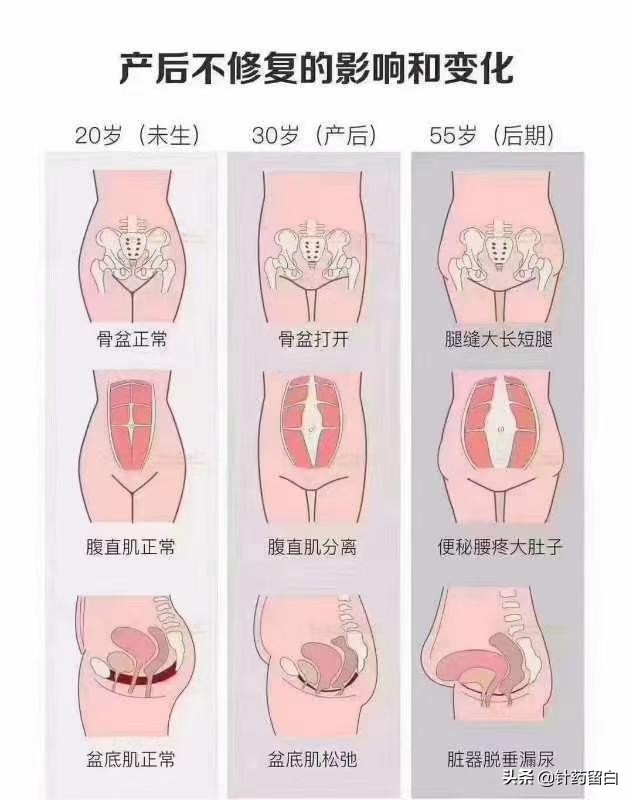 未婚女性盆底肌松弛漏尿怎么治疗,流产会导致盆底肌松弛漏尿吗