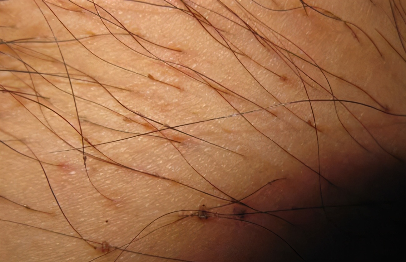 它们喜欢寄生在人的身体上行动迅速敏捷数量繁多