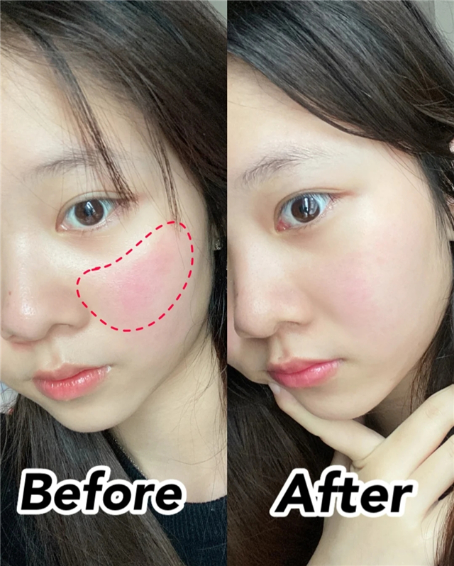 为什么一出门就脸红,夏天一出门就脸红怎么办