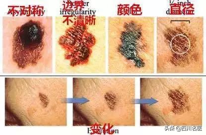 指甲上出现一条细线是怎么回事,女子指甲多出一条线为保命要截肢