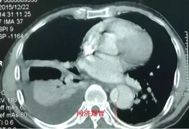 磁共振可以替代cta检查主动脉夹层,超声心动图联合cta诊断主动脉夹层