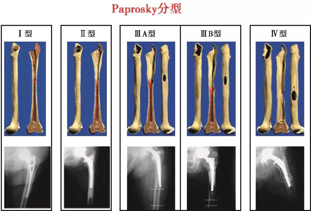 髋关节翻修术手术流程,人工髋关节翻修材料的选择