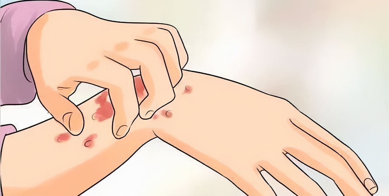 荨麻疹很痒忍下来有用吗,荨麻疹实在太痒了可以输液缓解嘛