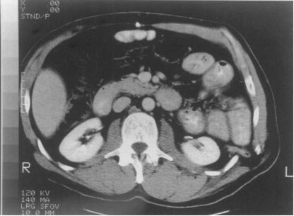 腹股沟疝有几种类型如何鉴别,腹股沟疝有哪些特点