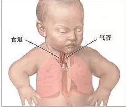 喉咙不舒服是咽炎还是胃食管反流,胃食管反流咽炎可以吃咽炎的药吗