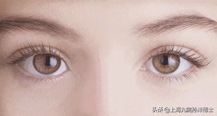 刚做完双眼皮闭眼总翻白眼正常吗,割了双眼皮为啥眼睛老流泪