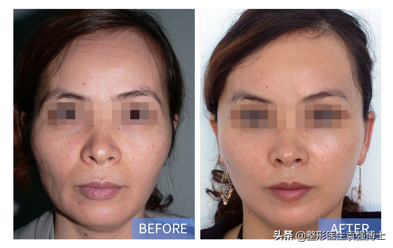 什么治法令纹最有效,天生就有法令纹去除不了吗