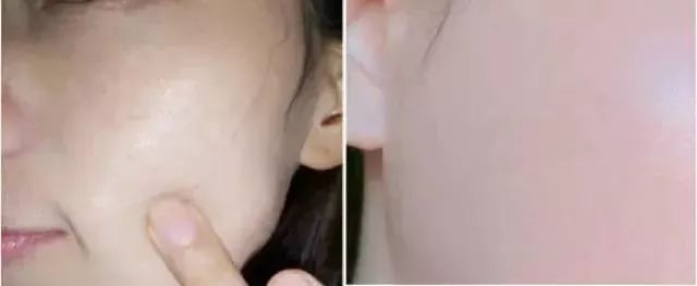 解决黑头的2种药,解决黑头的最好方法