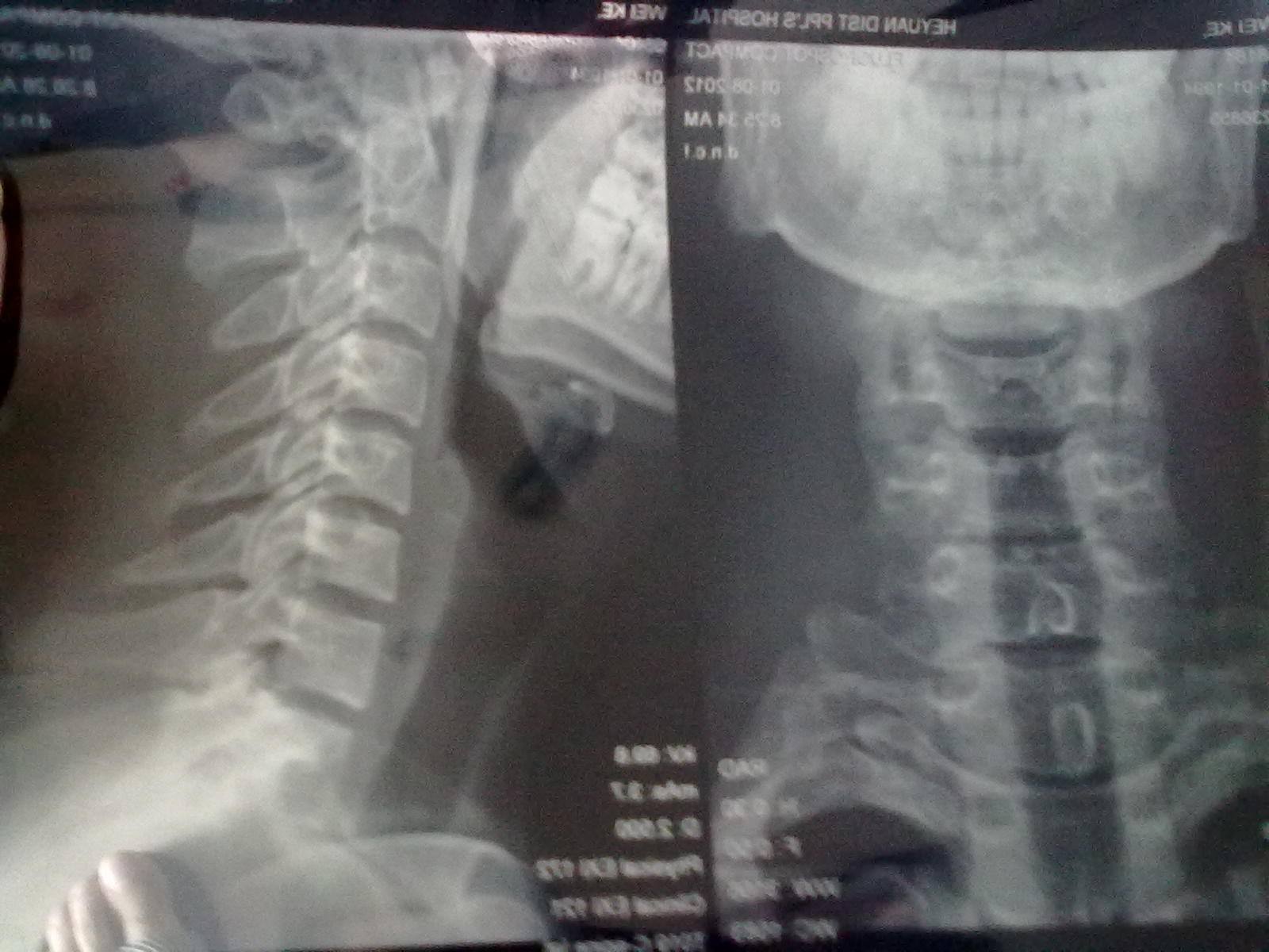 颈椎骨质增生伴曲度变直怎么回事,颈椎增生曲度变直会引起低压高吗