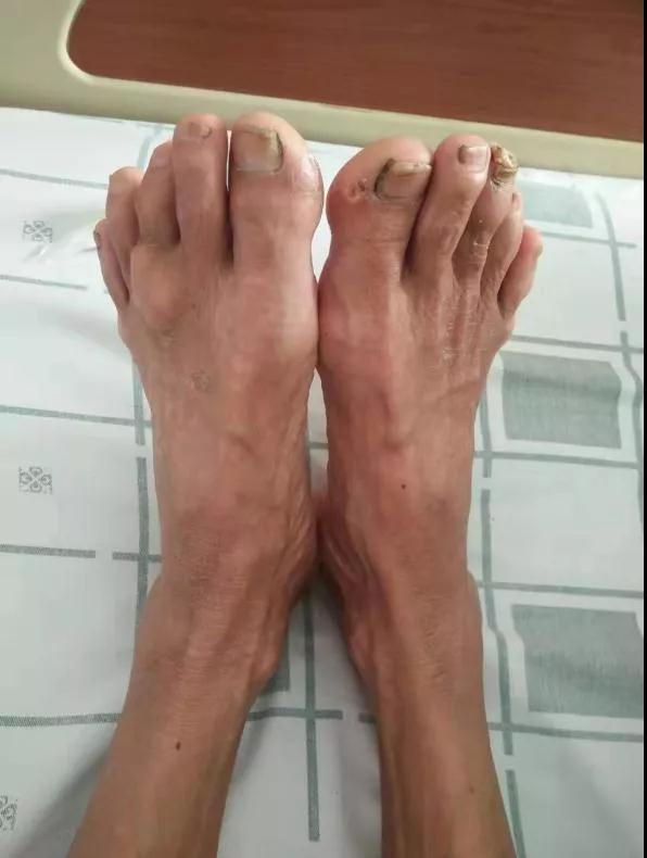 痛风没发作是不是就不用治疗,痛风没发作还用忌口吗