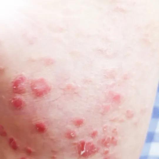 牛皮癣全身红斑大爆发怎么办,全身长满了牛皮癣属于重度吗