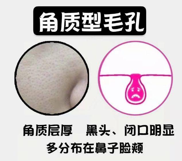 毛孔粗大黑头多怎么改善小技巧,毛孔粗大黑头多的原因和改善方法