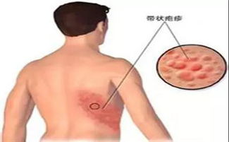 带状疱疹好治疗吗,带状疱疹合并糖尿病为什么难治