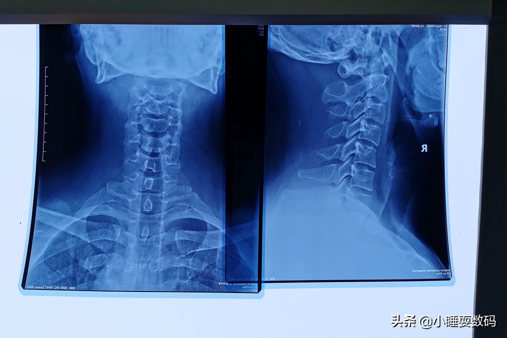 健康科普颈椎不好枕头应该怎么选,枕头选不好导致颈椎病