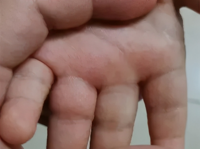 天一热手上就起一层小疙瘩还很痒,两只手上长密集的小疙瘩很痒很红