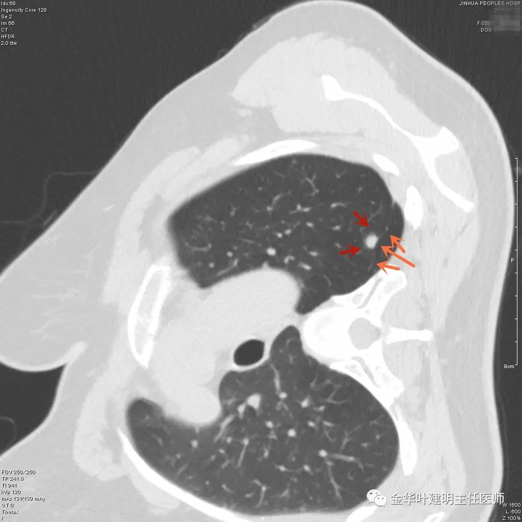 叶建明谈胸膜下的实性结节,叶建明肺实性良性结节会变癌症吗