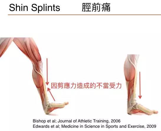 将近一半跑者都会遭遇的伤病,你中枪了吗?