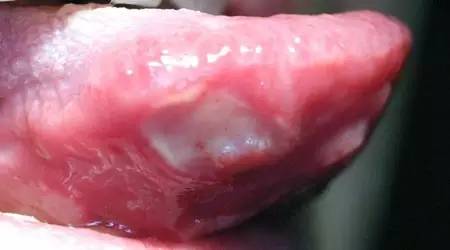 口腔溃疡是不是疱疹性口腔炎,口腔的常见20种疾病及治疗方法