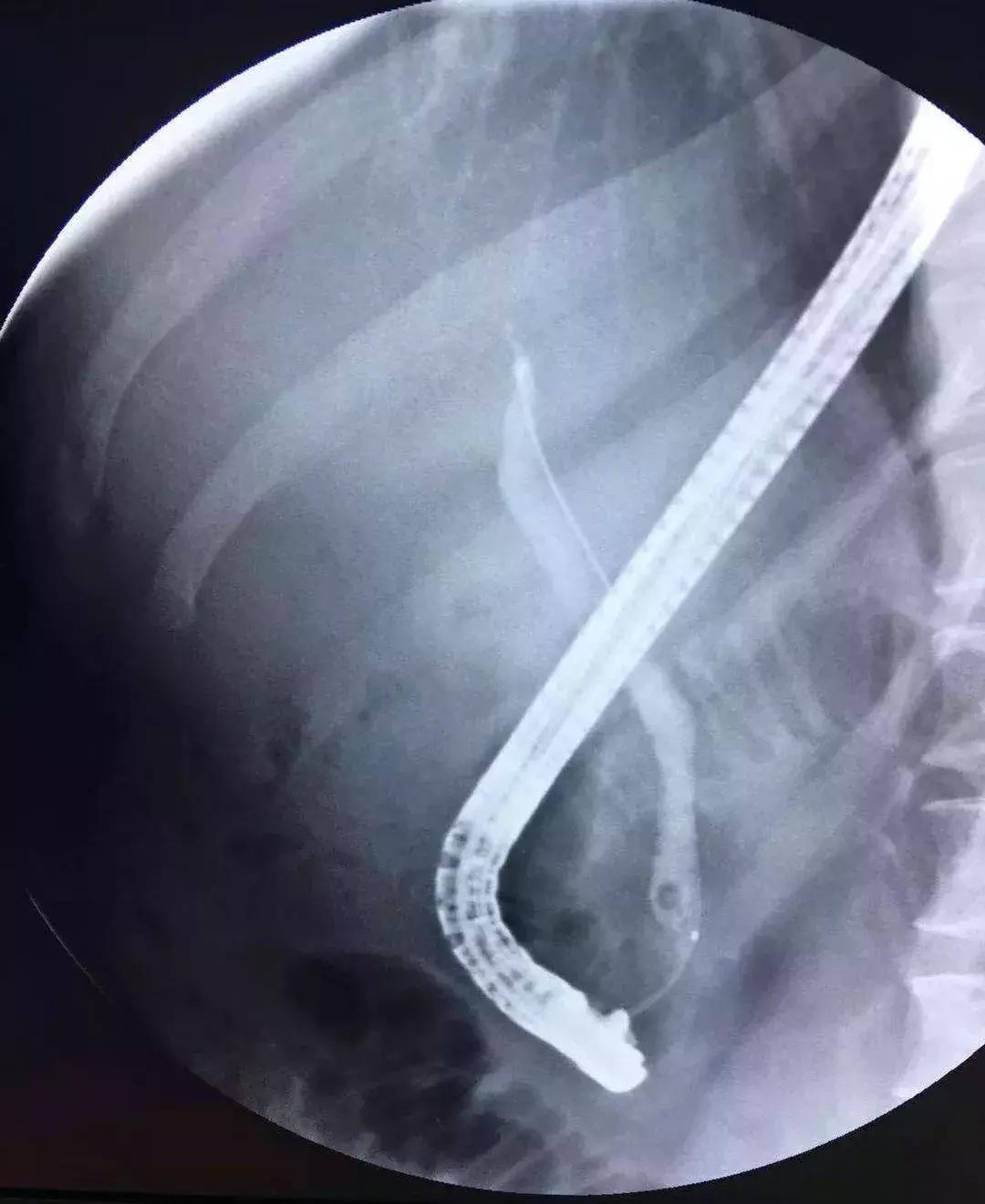 胆囊炎和胆管炎会出现黄疸嘛,化脓性胆管炎会出现黄疸吗