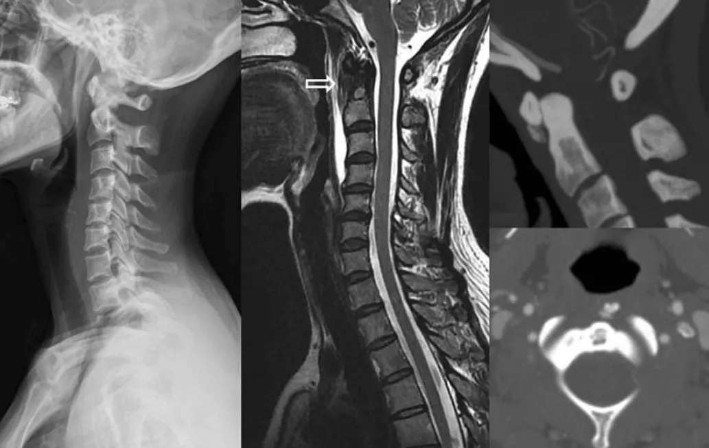 睡醒后脖子酸痛动不了怎么办,睡醒脖子痛不能扭头起身困难