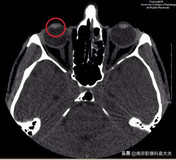 22岁男子眼睛意外失明,中年男子突然右眼失明半小时