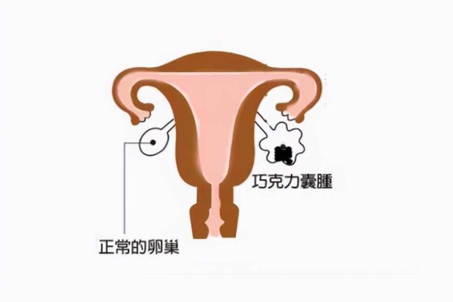 囊肿囊壁厚薄不均,囊肿卵泡分不清