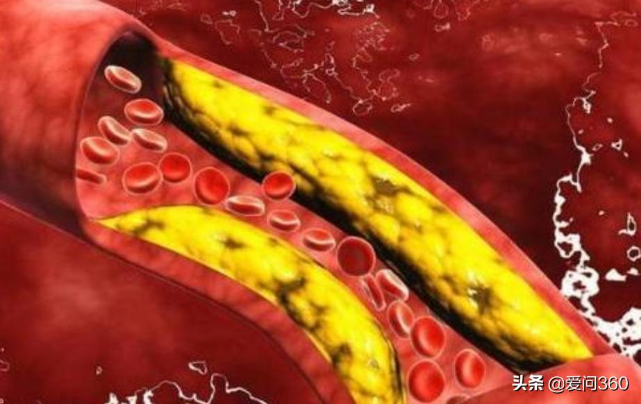 70岁老人血粘度低,老人血粘度偏高怎么调理