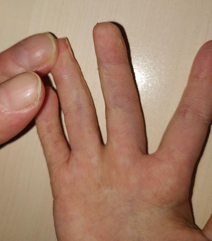 并指畸形免植皮案例,并指畸形