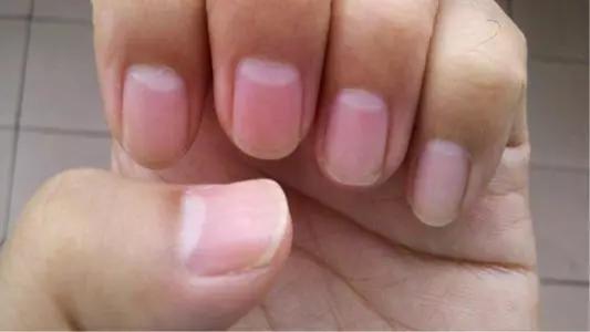 指甲半月牙少是怎么回事,指甲上月牙少是不是身体不好