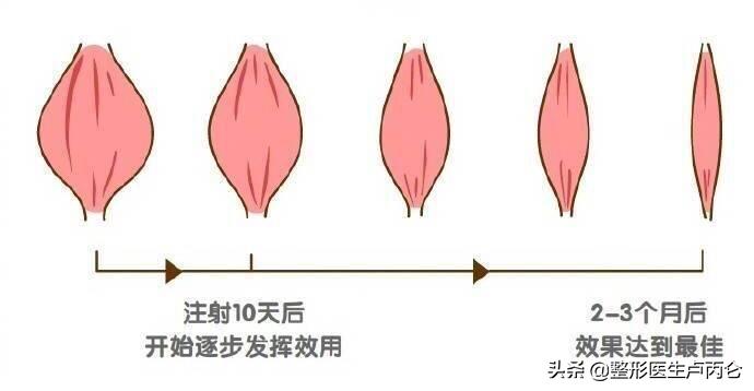 肉毒素咬肌注射多久见效,注射肉毒素咬肌凸起