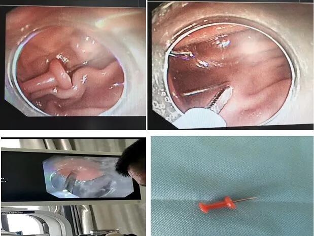 9岁男童把图钉当口哨吹吞掉下去,幼儿园儿童误吞图钉死亡