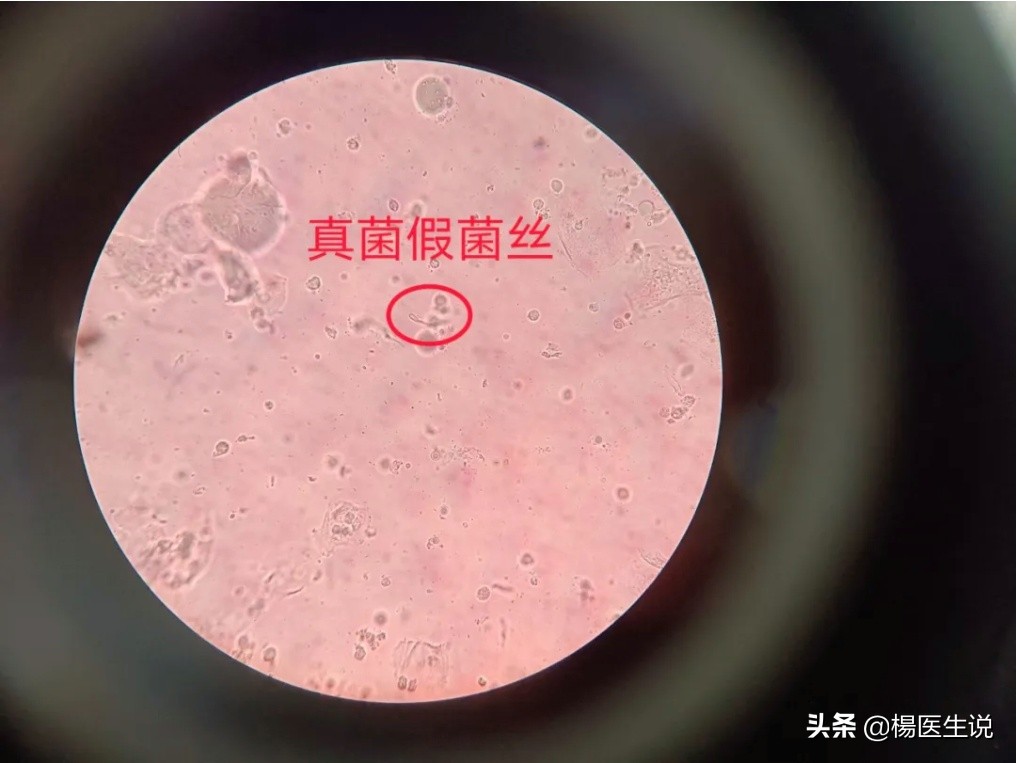 滴虫性阴道炎和霉菌性症状区别,滴虫性阴道炎与假丝酵母菌的区别