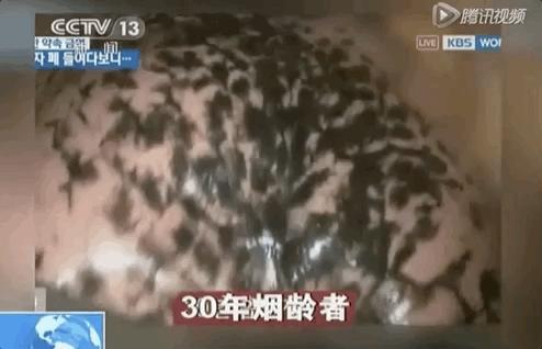 打开死者的肺,才明白有3亿人,在悄悄花钱买死