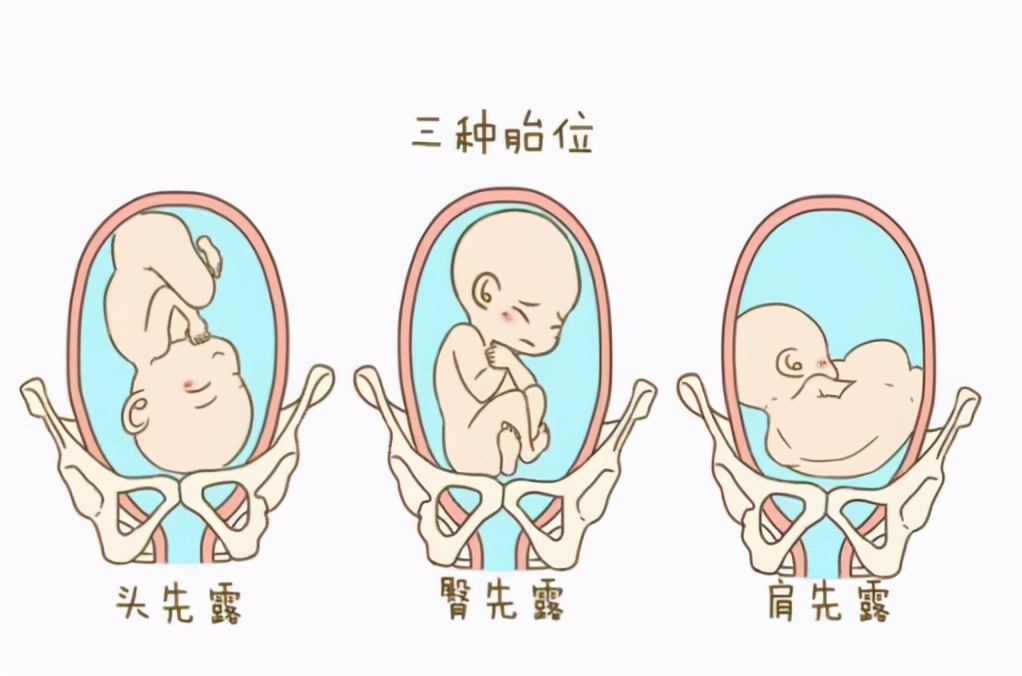 胎位左枕前位适合顺产吗,第三胎胎位右枕前位需要注意什么