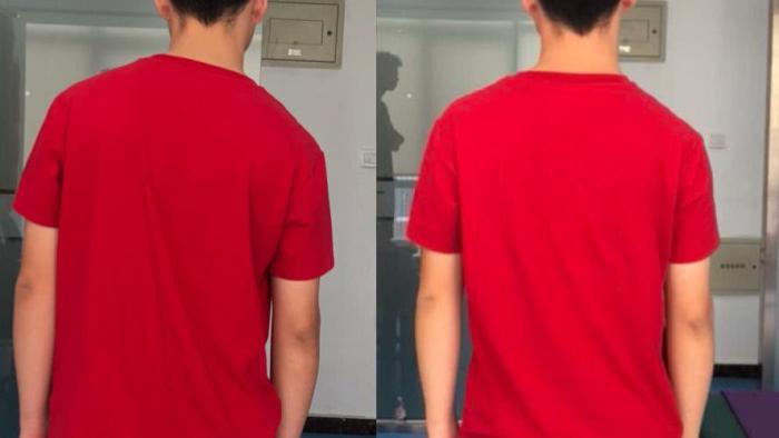 常见的体态问题--高低肩的处理方法