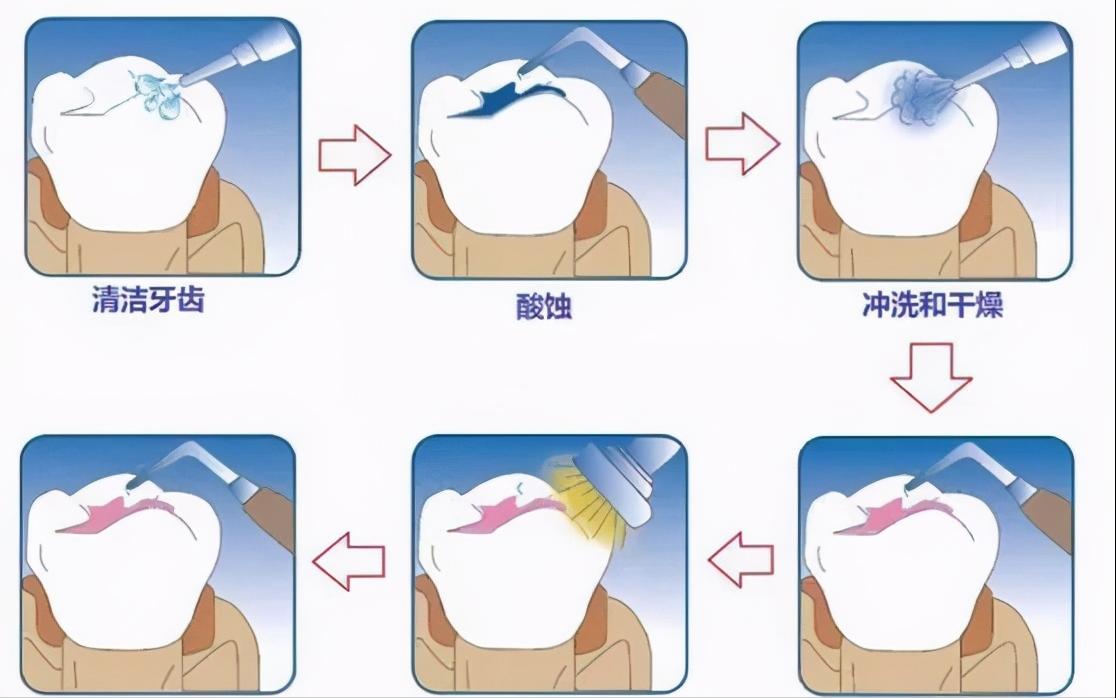 孩子开始换牙需要注意什么,孩子换牙期间这5件事需重视