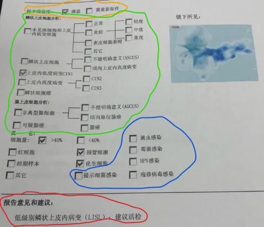 怎样看懂宫颈癌筛查报告单,一分钟看懂宫颈癌筛查方法