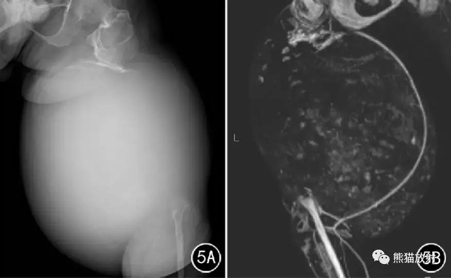 假性血友病什么症状,血友病病理