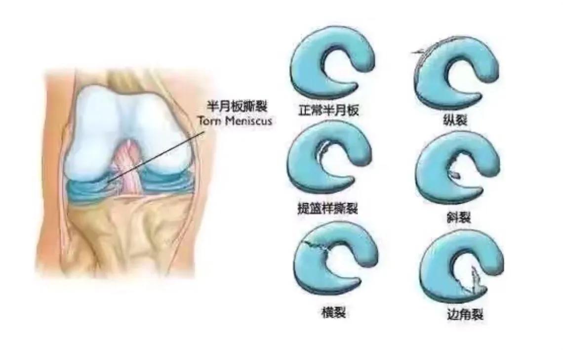 让腿又细又长,怎样锻炼可以改善假胯宽大粗腿