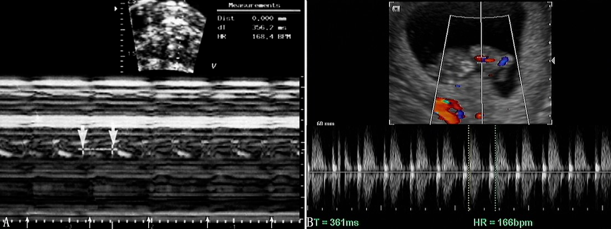 明明白白做超声（21）：胎儿发育生物物理学监测2-胎心活动及胎动
